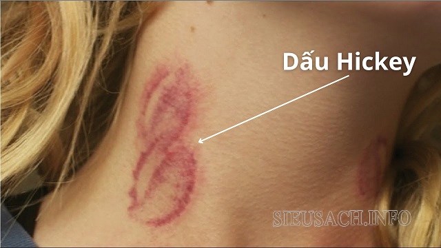 Hickey là dấu hôn trên da