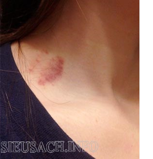 Hickey được cho là hoàn toàn vô hại