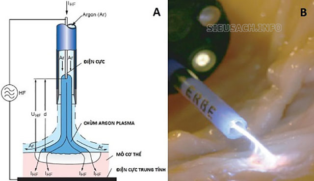 Argon lỏng được dùng để loại bỏ mô ác tính trong y tế