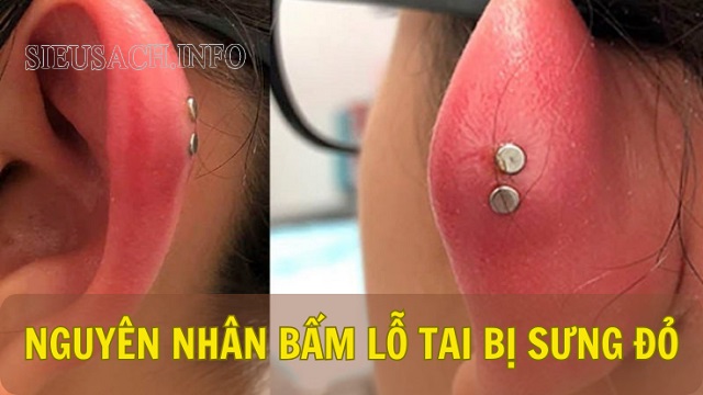 Nguyên nhân sau bấm lỗ tai bị mưng mủ, sưng tấy