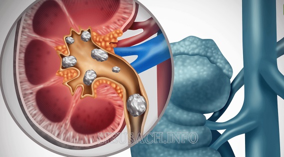 Xá lợi hình thành có thể do bệnh lý như sỏi mật, sỏi thận